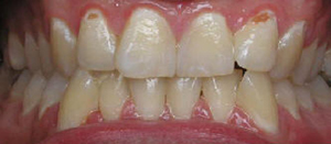 gum disease