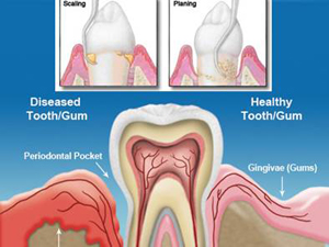 gum disease2