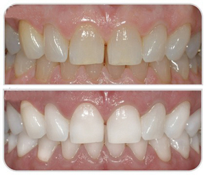gum disease